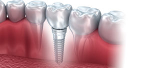 dental implants model